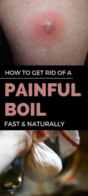 HOME REMEDIES TO GET RID OF A PAINFUL BOIL post thumbnail image