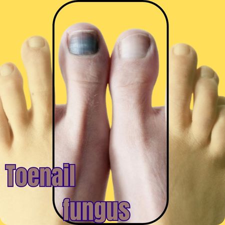 how to treat toenail fungus naturally post thumbnail image
