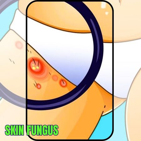 REASONS FOR GETTING SKIN FUNGUS AND HOW TO PREVENT IT post thumbnail image